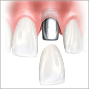Implantat Einzelzahn