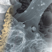 Knochenaufbau Implantat