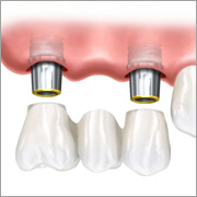 Teilbezahnung Implantologie